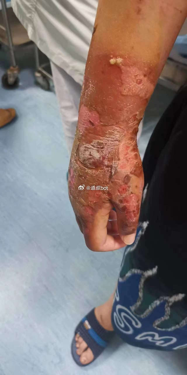 广东多名中学生出操被地面烫伤