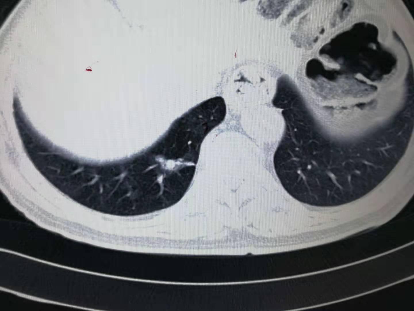 27岁女子肺结节没在意 1年后确诊肺癌：年轻不是免死金牌，这些信号千万别忽视！