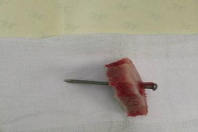 医学奇迹！女子大脑插6cm钢钉竟避开所有致命区域，医生直呼"不可思议"